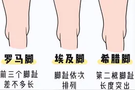 人的脚型主要分为这三类，这种脚型更易出现大脚骨拇外翻！图片