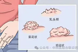 男性HPV感染警示，4大症状，不容忽视，赶紧自查！图片