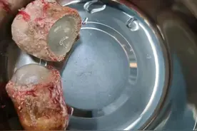 90岁老奶奶反复下腹坠胀、尿频，手术取出近7厘米结石图片