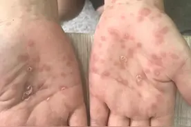 梅毒可怕？HIV感染者更要谨防！阻断措施有必要了解一下图片