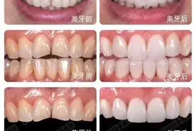 牙齿美容新宠——瓷贴面：适用于哪些牙齿情况？图片