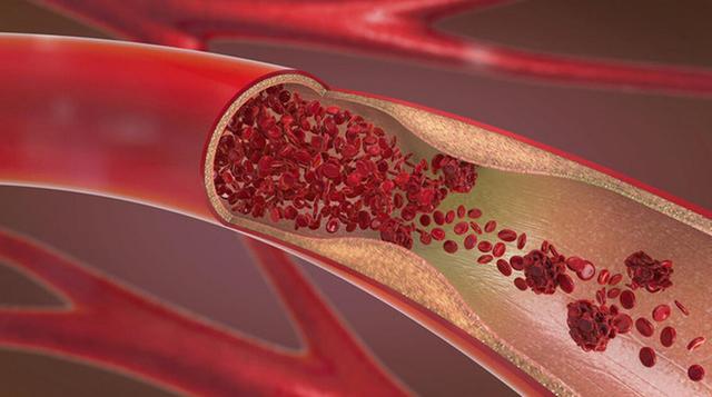 人有没有高血压	，散步就知道？有高血压的人，散步常有这3个表现
