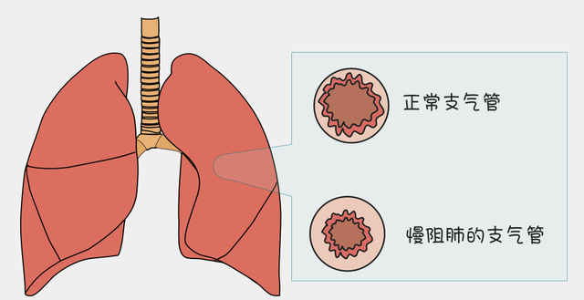肺栓塞去世的人越来越多？医生：天热宁可躺着，也别做这4件事
