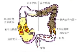 左半结肠癌和右半结肠癌的差异图片