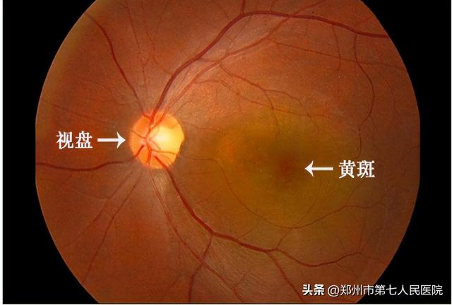 黄斑区水肿怎么治（黄斑水肿如何消专家这里有新招儿）