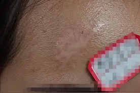 脸上疤痕黑色素沉淀如何去除？其实并不难！图片