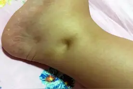53岁大妈小腿肿胀，以为是久坐引起，7个月后去世：早了解早规避图片