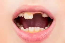 拔牙后，种牙还是镶牙？医生告诉你该如何选择！图片