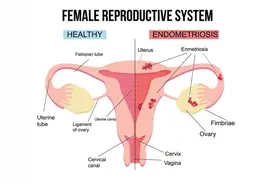 什么是“纳氏囊肿”？宫颈“纳氏囊肿”会变癌吗？让医生告诉你图片