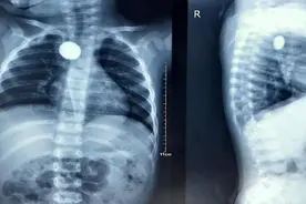 1岁多宝宝误吞纽扣电池，生命垂危……图片