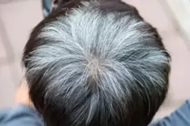 缺什么维生素会长白发？导致白发的原因有哪些呢？医生来告诉答案图片