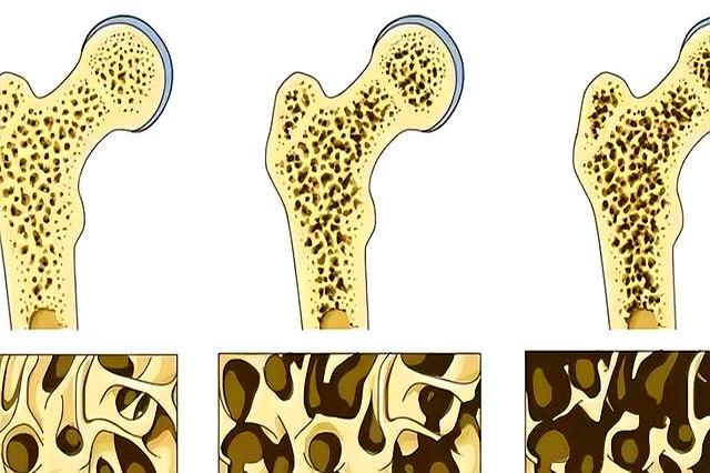 学医后才明白，增强骨密度最好的运动，不是散步游泳，而是这个