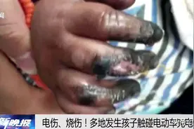 宝宝安全警报：1岁婴儿手指瞬间焦黑，罪魁祸首竟它！图片