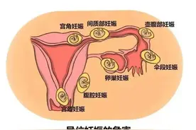 受精卵迷路了？——宫外孕那些事图片