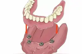 半口半固定种植牙是什么意思?与全固定种植牙有啥区别？图片