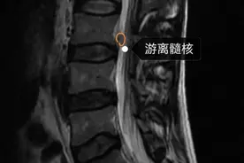 7毫米“钥匙孔”解顽疾 精准微创守护生命脊梁！“毫米级”技术精准解除腰椎间盘突出剧痛图片