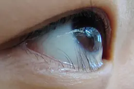 倒睫毛影响孩子的视力，值得家长关注。图片