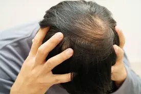 “秃顶”的祸首被揪出，50岁后要少碰，老人或发量茂盛图片