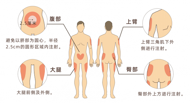 如何正确注射胰岛素