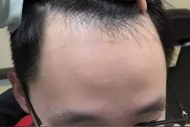 头发又粗又硬，和头发又细又软的人，谁更容易秃？事实证明图片