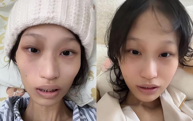 广东“天使女孩”梁希怡去世，仅21岁，生前被误诊，生日当天截肢