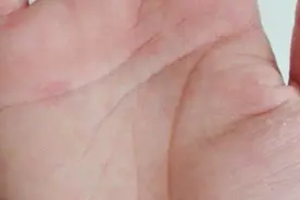 治疗多汗症的方法图片