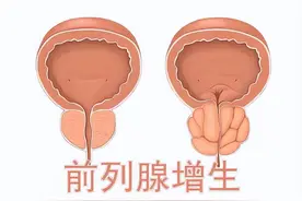 前列腺增生两年了，每天都要吃坦索罗辛，停药就尿频，该怎么办？图片