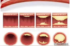 强化降脂是逆转颈动脉斑块的最有效手段！哪些药最有效？（9）图片