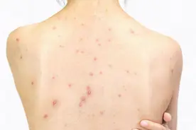 后背总容易长痘痘？皮肤科医生：或是这几种疾病前兆，趁早去医院图片