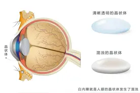 白内障知多少图片
