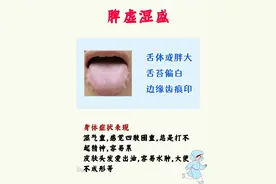 舌苔看健康 每天早上起来一分钟对镜自查图片