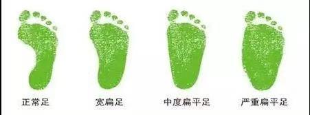 为什么扁平足不能当兵？怎样才能改善扁平足