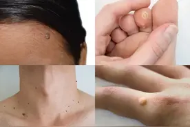 感染 HPV 有哪些表现？这几种症状，太容易被忽略！图片