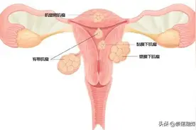 女子爱生闷气子宫长出8个肌瘤！这种病真的是气出来的吗？图片
