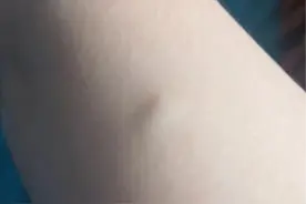 不可忽略的皮肤疙瘩——表皮囊肿图片