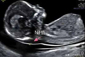 孕12周NT检查结果不合格怎么办？不超过这个“界限”就可以了！图片