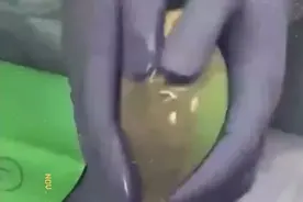 不可思议！假体隆胸14年取出假体，竟然能拉丝了！网友直呼太吓人图片