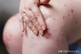 瘙痒真的很难受，快速止痒的八个方法图片