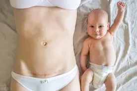 剖腹产疤痕痒得难受？医生来支招：这5招让你轻松止痒！图片