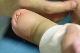 可爱宝宝手脚被羊膜束带缠上，指头挤成一团，还能分开5指吗？图片