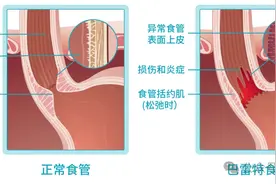 癌前病变——巴雷特食管，到底长啥样？该怎么治？图片