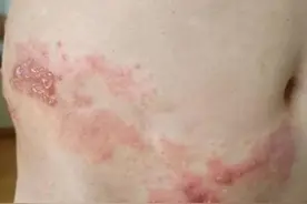 蛇年说“生蛇”，皮肤科医生为您澄清带状疱疹的16大误区！图片