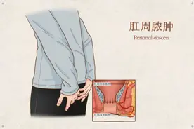 济南市莱芜人民医院：治愈肛周脓肿 手术治疗要趁早图片