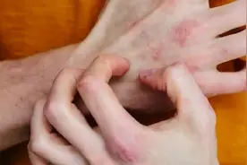 冬天是湿疹的高发季，两类人更要警惕图片