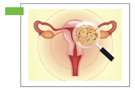 阴道炎的类型及其特点图片