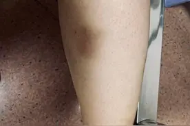 蚊子“偏爱”这些人 夏季还要小心蠓图片