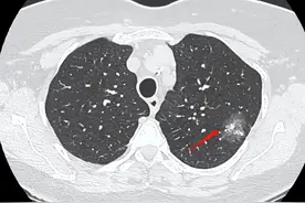 41岁肺结节10毫米，自费1万出头在昆明手术，术后很不幸都是恶性图片