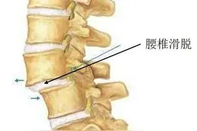 同仁医院这项技术让患者远离腰椎滑脱图片