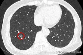磨玻璃结节很可怕？磨玻璃结节长到多大容易变成肺癌呢？图片
