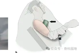 经典再现｜详解肱骨近端骨折微创钢板治疗的步骤技巧图片
